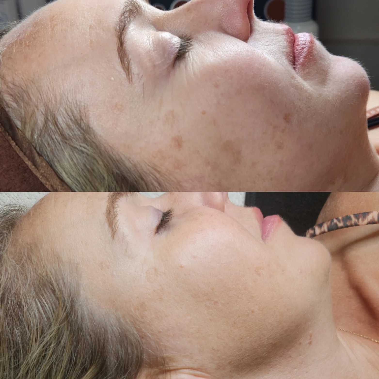 Stacked two-frame comparison of a client's cheek showing pigmentation clearly reduced in the lower frame