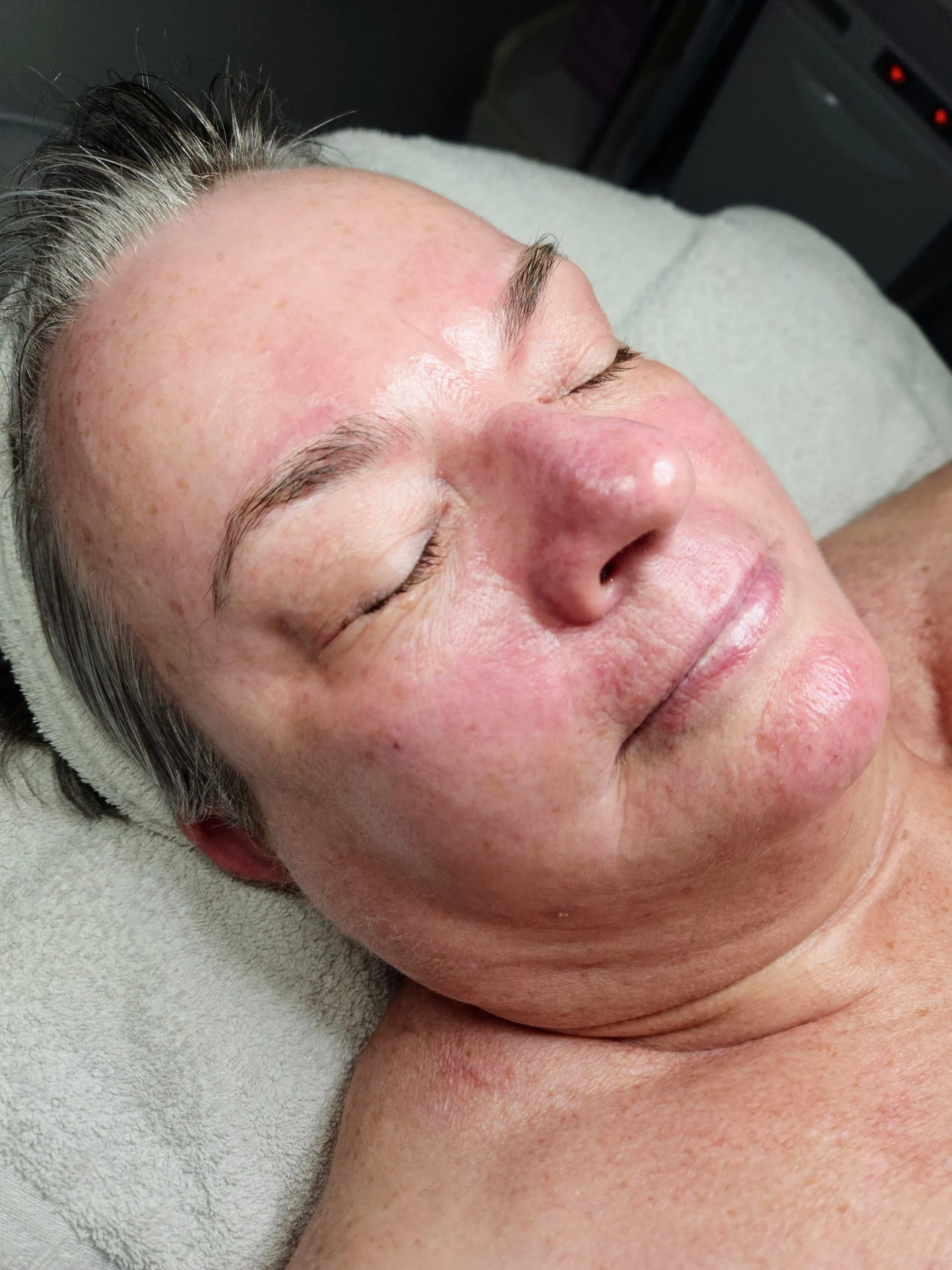 Same client after treatment, redness markedly calmer and skin even