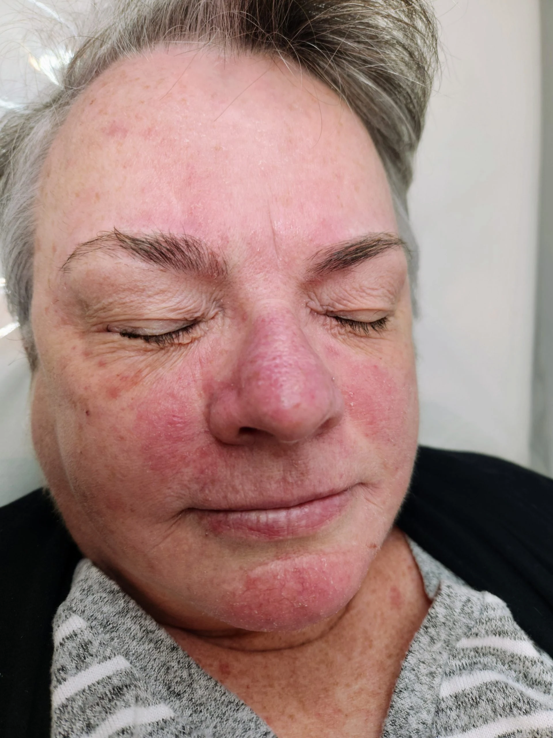 Client before treatment showing pronounced rosacea flushing across cheeks, nose and chin
